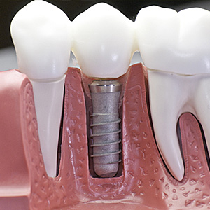 implant